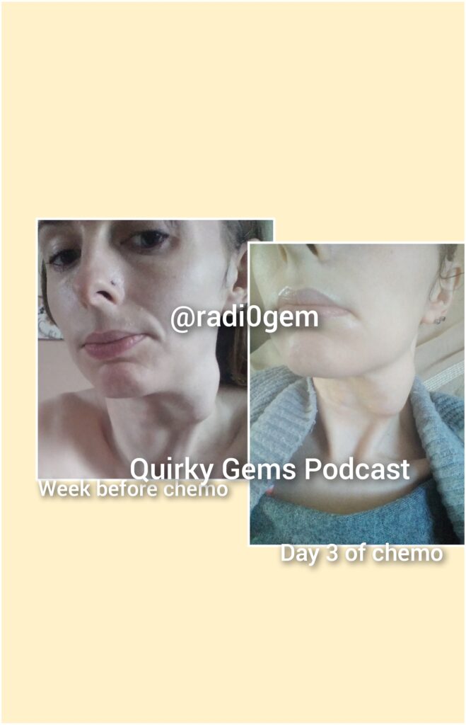 Graphic of Gem Swallows lump on neck a week before chemo therapy and a photo of the lump on day 3 of chemo therapy